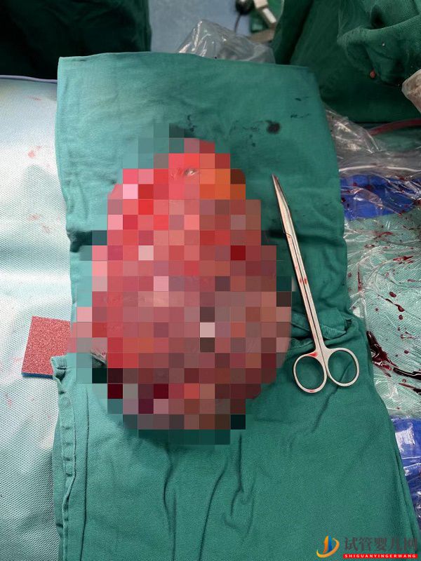 7斤2兩！女子高挺肚子像孕婦，醫(yī)生取出巨大腫瘤(圖2)