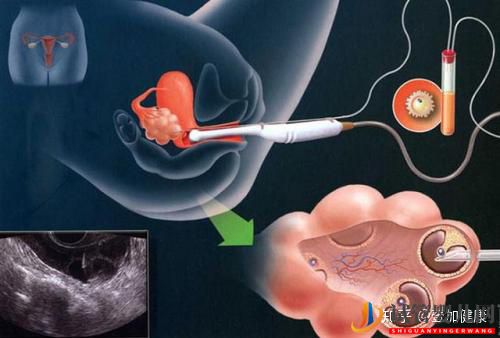 試管嬰兒過程中的取卵手術(shù)真的很痛嗎_看完你就安心了(圖1)