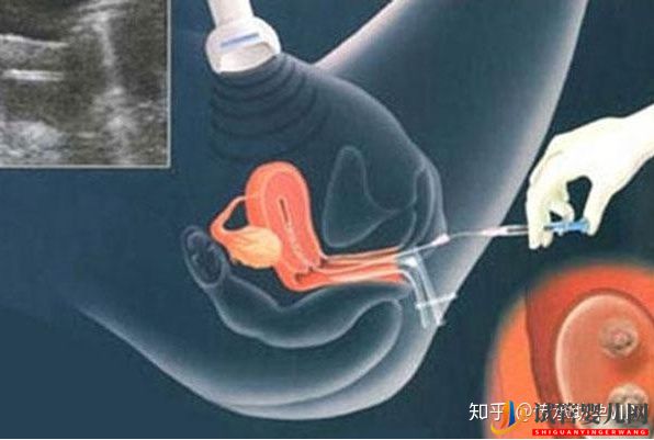 烏海試管嬰兒全過(guò)程需要多少時(shí)間(圖1)