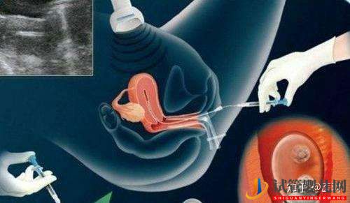 做試管嬰兒取卵手術的過程疼嗎(圖1)