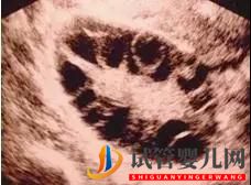 做試管嬰兒用的小卵泡穿刺是什么？適合什么人群？(圖1)