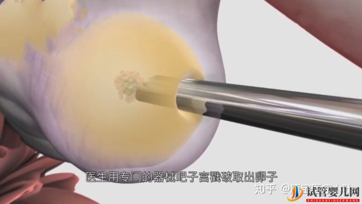 做試管嬰兒有多痛,幾張3D模擬圖,看完全過程后心(圖4)