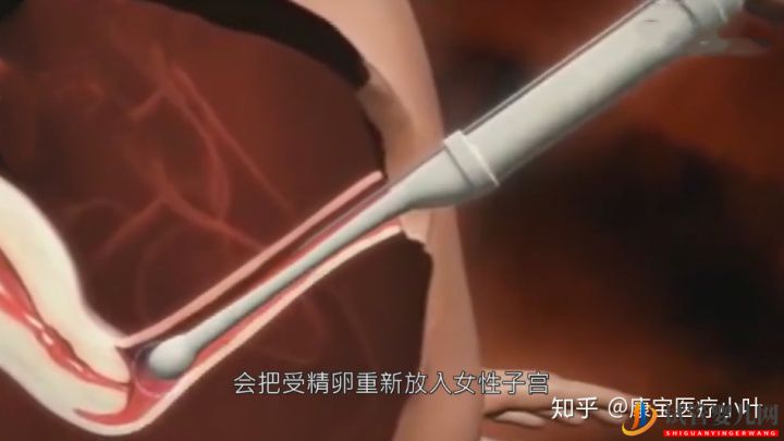 做試管嬰兒有多痛,幾張3D模擬圖,看完全過程后心(圖7)