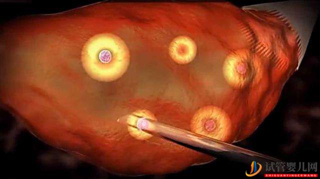 美國試管嬰兒取卵時全麻操作解析(圖1)