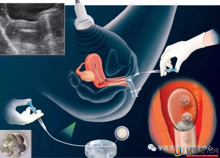 試管嬰兒技術,美國vs中國(圖3)