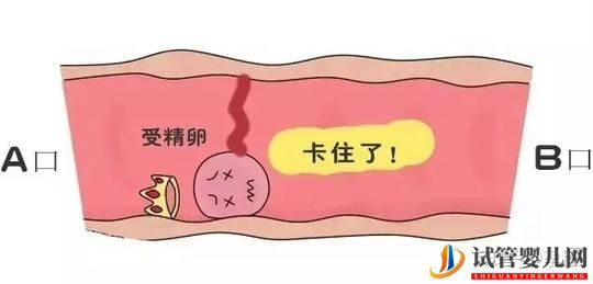 輸卵管堵塞還想懷寶寶!能夠做泰國試管嬰兒嗎(圖4)