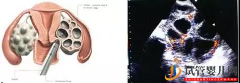 AMH能預(yù)測(cè)試管嬰兒成功嗎？(圖1)