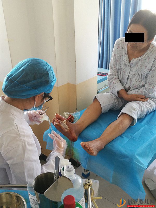 糖尿病并發癥糖尿病足到底有多可怕，可以避免截肢嗎？(圖1)