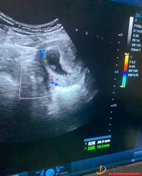 我的三代試管成功之路,重點(diǎn)說(shuō)說(shuō)三甲醫(yī)院試管綠通預(yù)...(圖6) 我的三代試管成功之路,重點(diǎn)說(shuō)說(shuō)三甲醫(yī)院試管綠通預(yù)...(圖6)