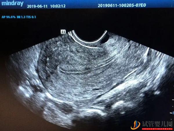 子宮內膜厚4.4mm狀態(tài)正常也別急！移植最佳厚度還沒到(圖3)