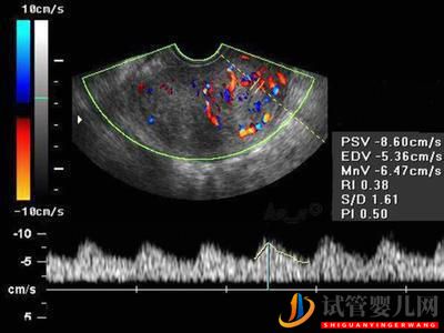 泰國試管嬰兒前：如何改善子宮內膜薄的情況？(圖2)