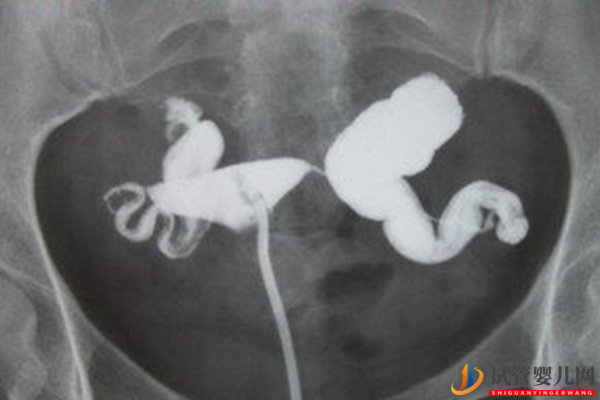 兩側輸卵管都切除了還能做試管？(圖2)