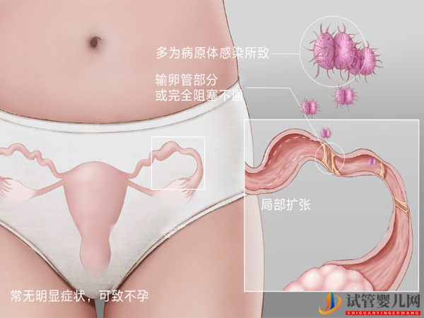 輸卵管堵塞影響試管成功率(圖1)