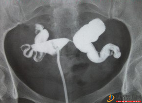 輸卵管積水做試管有明顯影響，要不要切除有兩種情況(圖2)