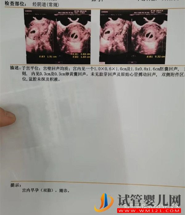 為什么做云浮試管嬰兒大部分是龍鳳胎試管媽媽告訴你(圖3)