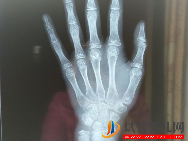 10-16歲兒童正常骨齡與身高對照表,免費(fèi)了解孩子生長潛力(圖1) 10-16歲兒童正常骨齡與身高對照表,免費(fèi)了解孩子生長潛力(圖1)