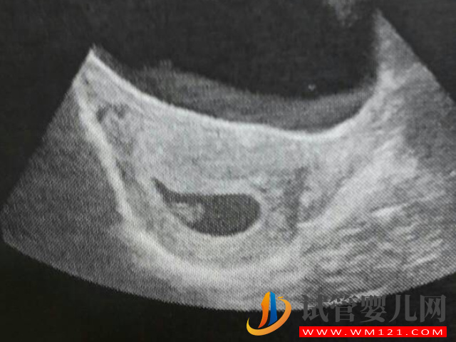 孕囊大小與孕周正常對照表，50天孕囊在范圍就無須擔心(圖2)