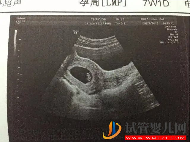 孕囊大小與孕周正常對照表，50天孕囊在范圍就無須擔心(圖3)