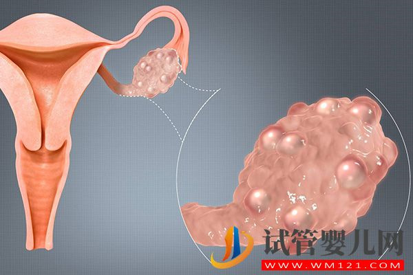 一文說清中醫能否三個月治好多囊卵巢，這2種療法可了解(圖1)