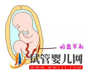 胎盤早剝是什么原因引起的?(圖1) 胎盤早剝是什么原因引起的?(圖1)