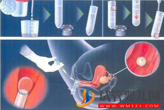 人工授精和試管嬰兒詳細(xì)介紹及對比？(圖1)