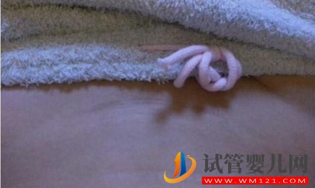 有過剖腹產(chǎn)做試管嬰兒可以懷雙胞胎嗎？要需要休息多久能做(圖3)