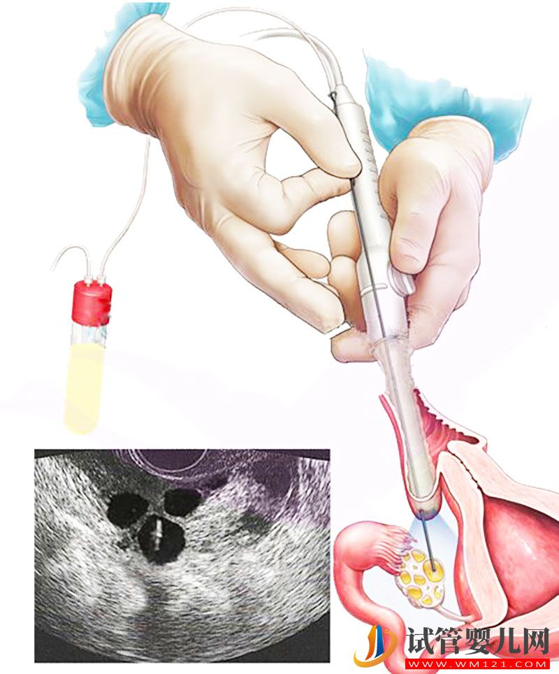 第一次做試管嬰兒你需要了解這22個常見問題(圖2)