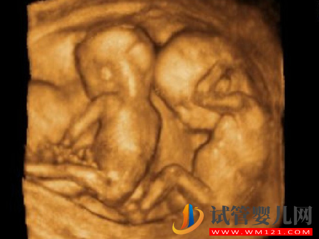 康定高齡產婦是做試管雙胎風險大還是減胎風險大？(圖1)