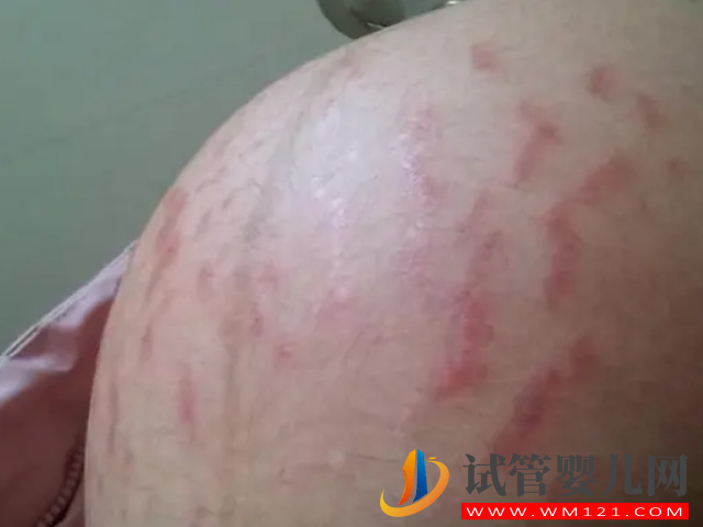 妊娠線粗細(xì)、長短都已暗示生男生女，不同性別區(qū)別真的很大(圖2)