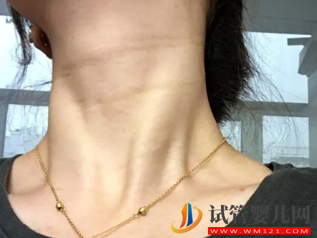 懷孕脖子、腋下變黑已暗示生男生女，孕晚期尤為明顯(圖2)