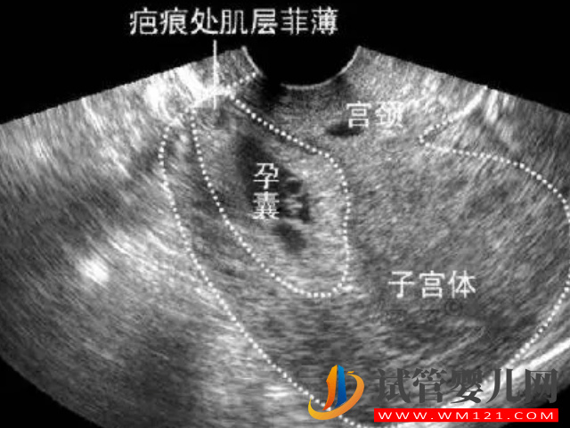 二胎38周剖腹產后遺癥太多！產后每天都在后悔(圖2)