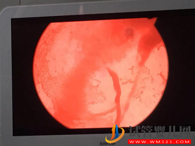 二胎38周剖腹產后遺癥太多！產后每天都在后悔(圖3)