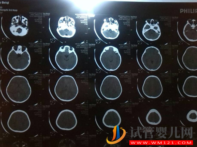 寶寶摔了千萬不要做腦部ct的原因匯總，過來人都直呼后悔！(圖1)