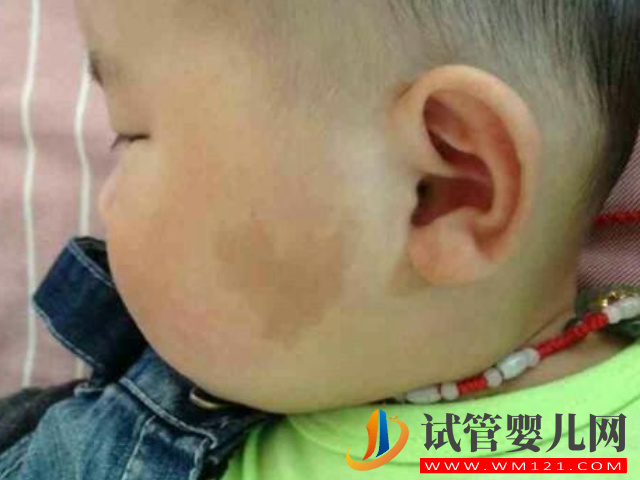 兒童不同位置胎記圖解大全，是福是禍點看看了才知道(圖3)