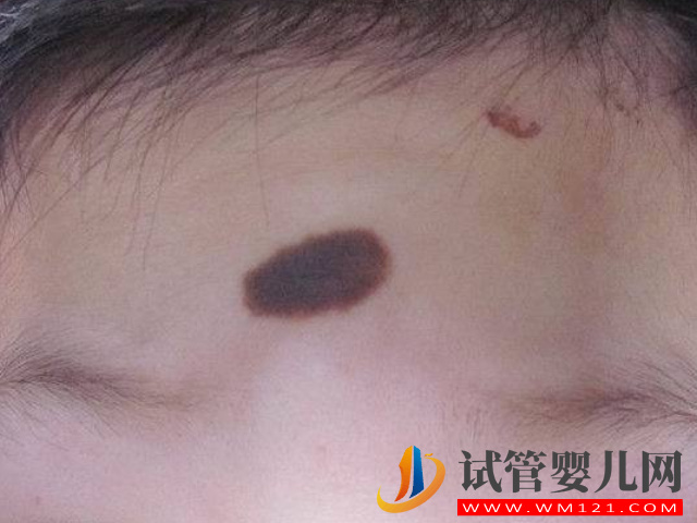 兒童不同位置胎記圖解大全，是福是禍點看看了才知道(圖4)