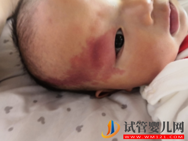 兒童不同位置胎記圖解大全，是福是禍點看看了才知道(圖6)