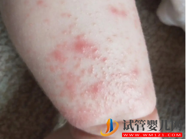 5種常見典型濕疹類型圖片分享，不同類型“防與治”都不一樣(圖6)