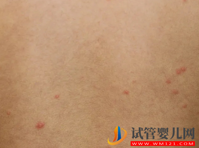 兒童、成人水痘自愈不是“夢”，簡單3招教你快速自救(圖1)