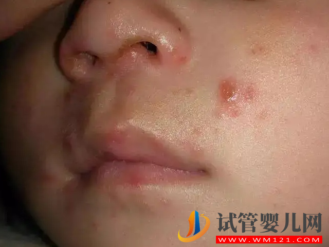 兒童、成人水痘自愈不是“夢”，簡單3招教你快速自救(圖2)