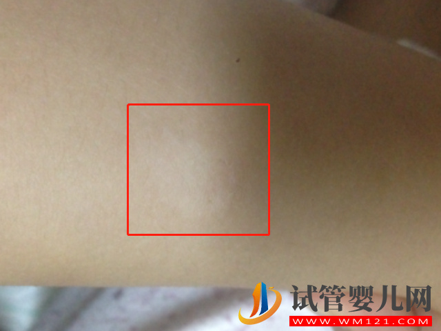 新生兒白色胎記圖片大全，發病幾率小但危害大(圖1)