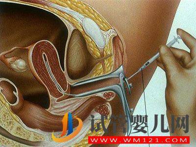 人流后發(fā)生不孕不育可以做試管嬰兒?jiǎn)?(圖1)