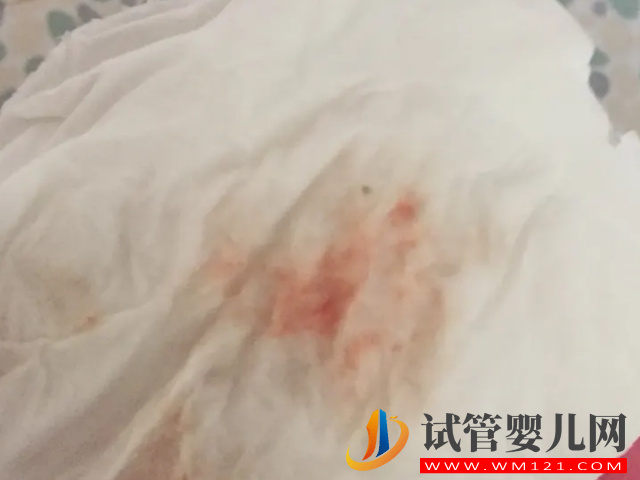 試管取卵對女性卵巢的危害大，術后出血千萬別大意(圖2)