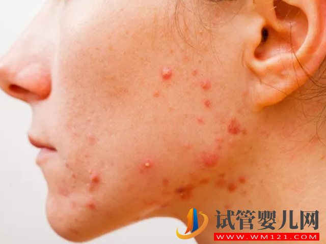 女性多囊長痘和普通長痘有區別，外在表現和癥狀都不一樣(圖2)