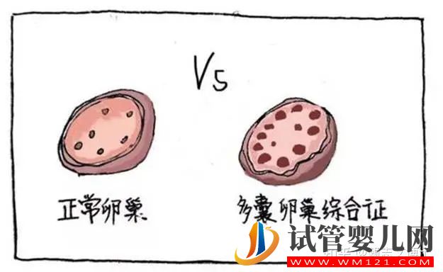 多囊卵巢和多囊卵巢綜合征的區別是什么(圖2)