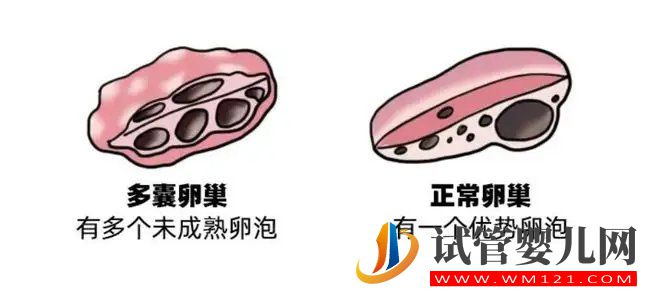 多囊卵巢有這些表現(圖1)