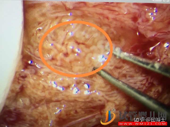 上海市一新增1例無精治療成功案例(圖2)