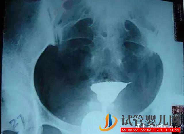 輸卵管造影片的解讀,你理解對了嗎(圖2)