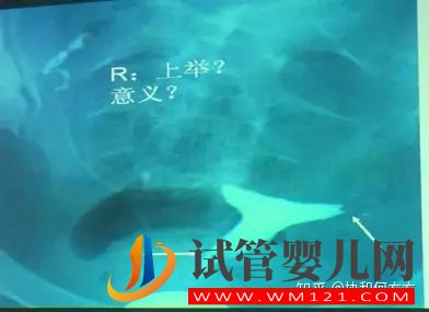 輸卵管造影片的解讀,你理解對了嗎(圖4)