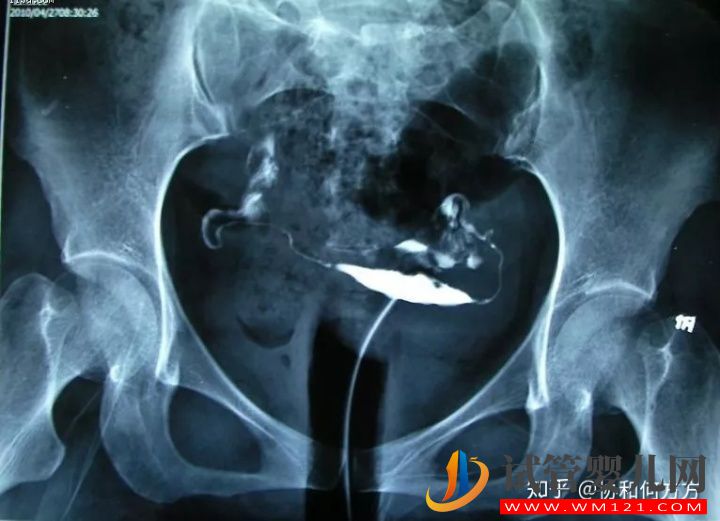 輸卵管造影片的解讀,你理解對了嗎(圖6)