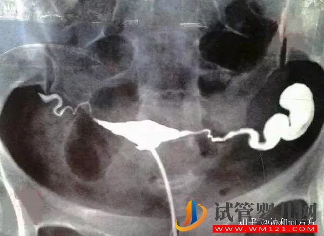 輸卵管造影片的解讀,你理解對了嗎(圖5)